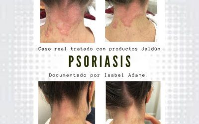 Solución a un importante caso de Psoriasis en el Centro Capilar Jaldún Ibela Belleza